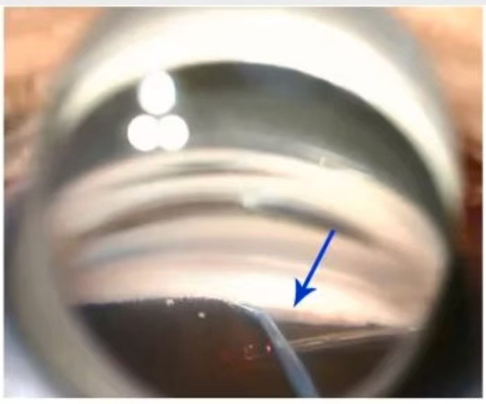 房角镜下手术内路小梁切开术